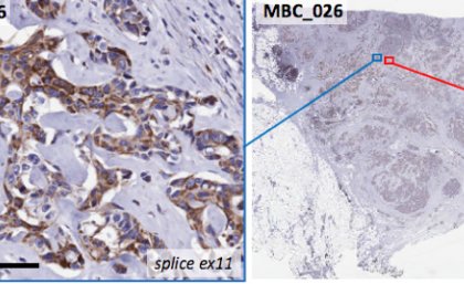 A scan of a single MBC tumour, with different regions containing diverse cell types.